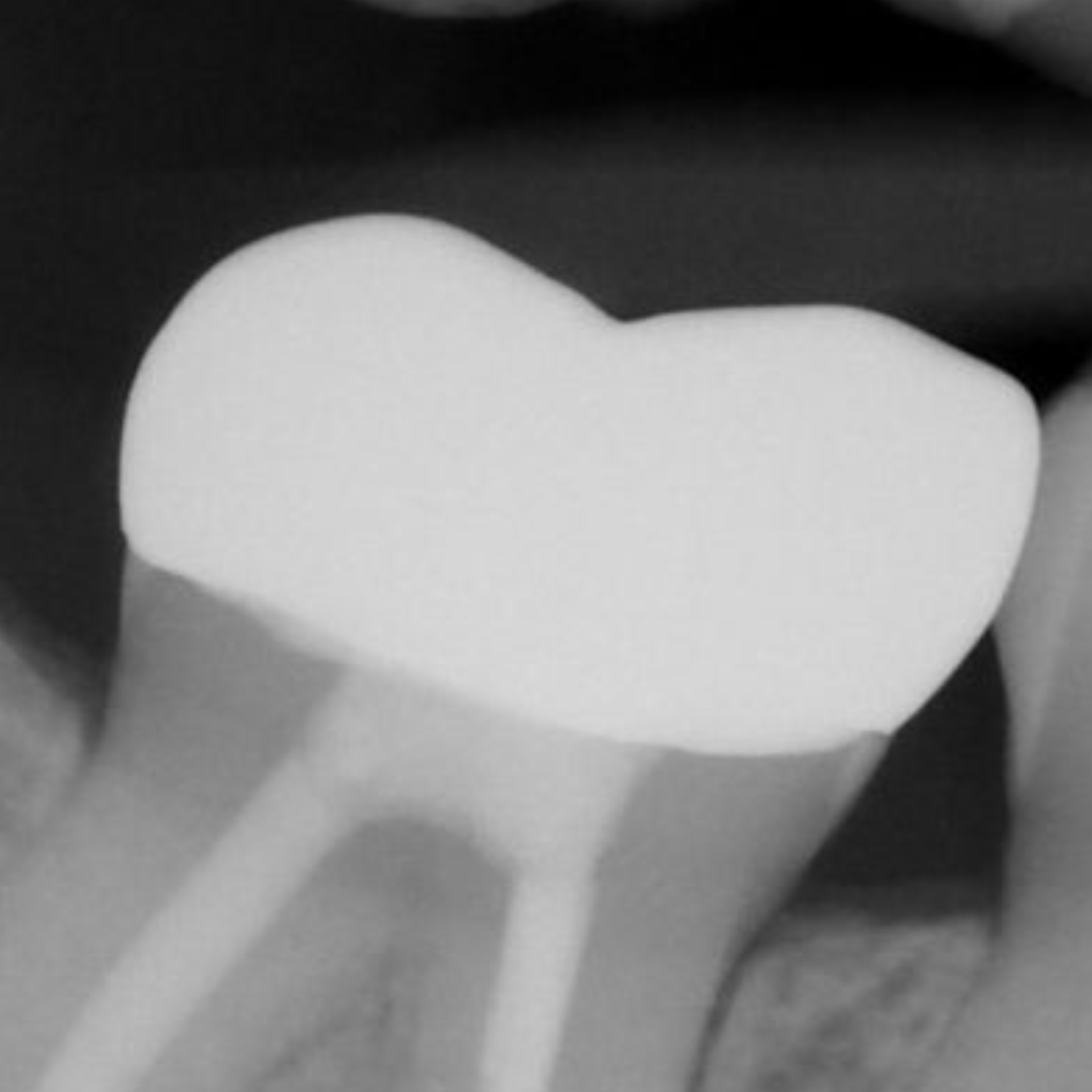 X-ray showing smooth crown margins